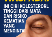 Waspada! Ini Ciri Kolesterol Tinggi dari Mata dan Risiko Kematian yang Mengintai