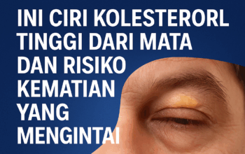 Waspada! Ini Ciri Kolesterol Tinggi dari Mata dan Risiko Kematian yang Mengintai